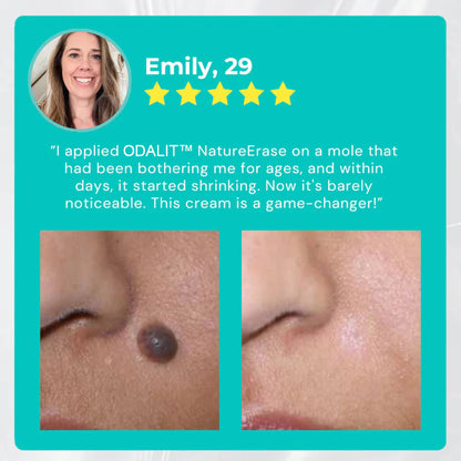 🔥Final 3 Hours: 80% OFF - ODALIT™ NatureErase Instant Mole & Spot Cream