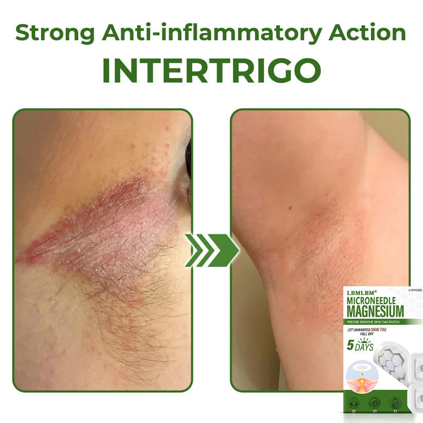 🔥Final 3 Hours: 80% OFF - LBMLBM® Magnesium MicroNeedle Precise Remove Skin Tag Patches