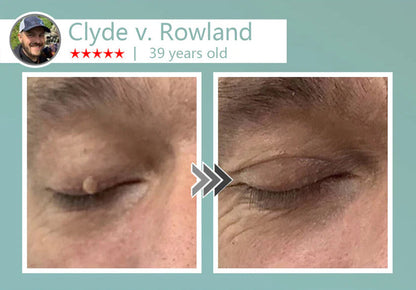 🔥Final 3 Hours: 80% OFF - LBMLBM® MicroNeedle Botanic Skin Tag Removal Patch 🇺🇸 Made in the USA