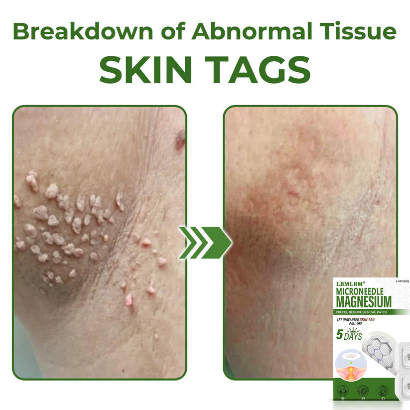 🔥Final 3 Hours: 80% OFF - LBMLBM® Magnesium MicroNeedle Precise Remove Skin Tag Patches