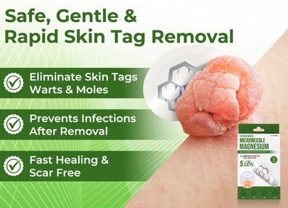 🔥Final 3 Hours: 80% OFF - CQGCQGQ® Magnesium MicroNeedle Quick Remove Skin Tag Patches