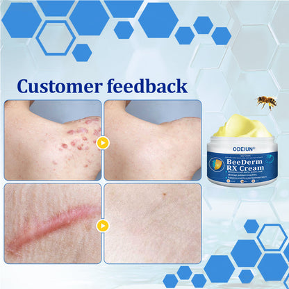🔥Final 3 Hours: 80% OFF - ODEIUN® BeeDerm RX Cream, Painless, Targeted Treatment for Warts, Skin Tags, Skin Lesions, Infections, Cysts, and Scars💛