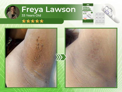 🔥Final 3 Hours: 80% OFF - CQGCQGQ® Magnesium MicroNeedle Quick Remove Skin Tag Patches