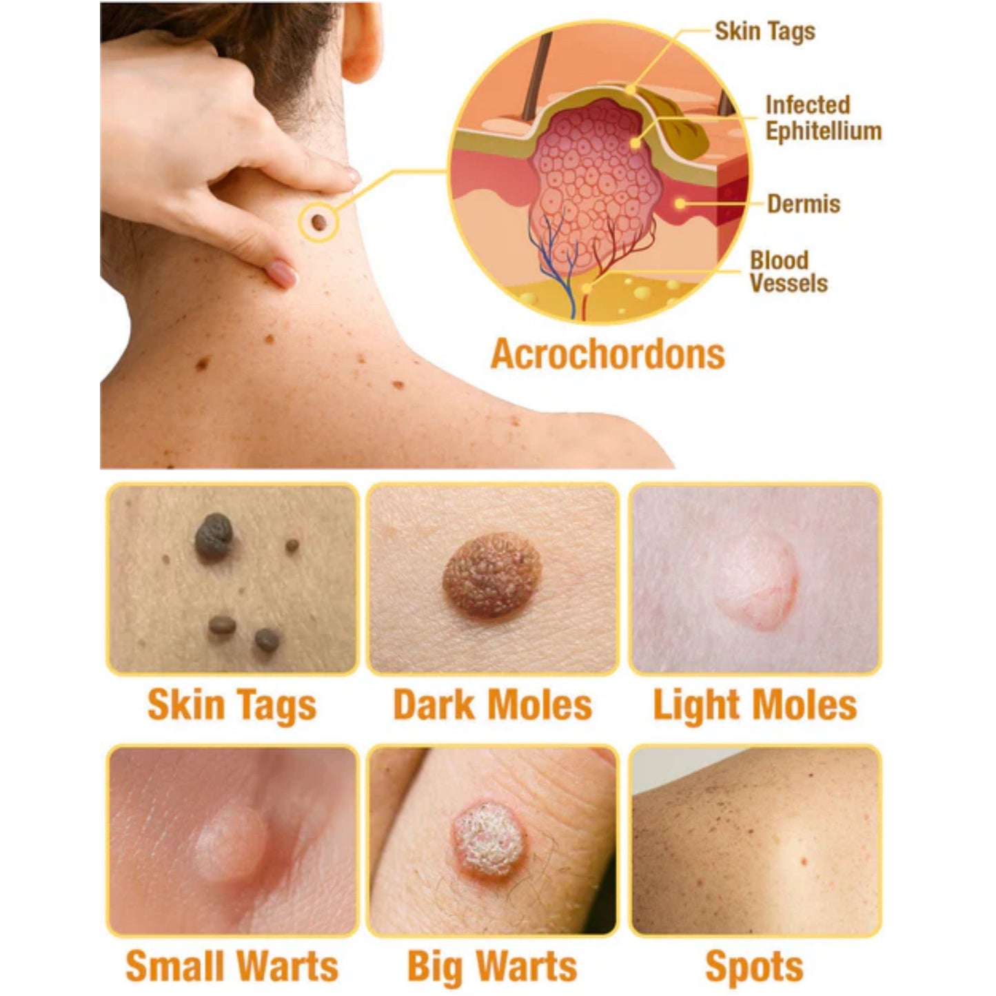 🔥Final 3 Hours: 80% OFF - LBMLBM™ TagRecede Bee Venom Treatment Spray