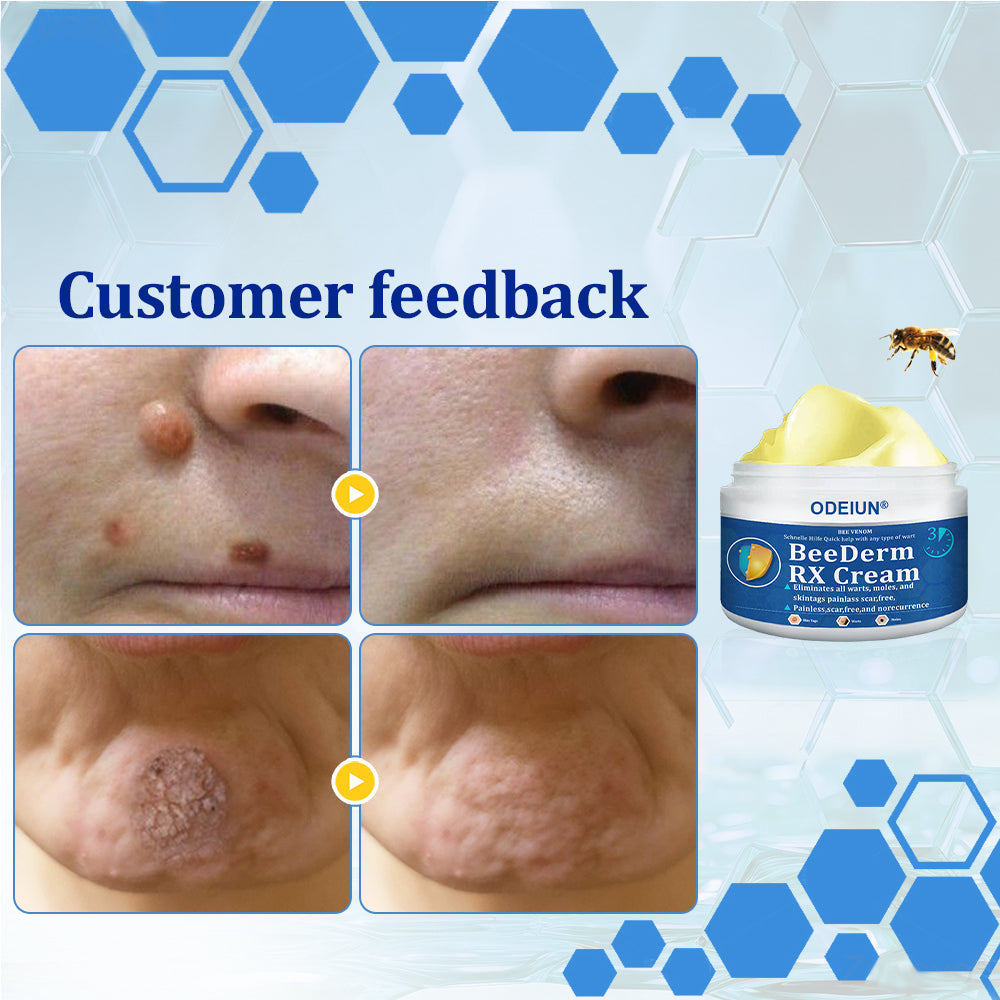 🔥Final 3 Hours: 80% OFF - ODEIUN® BeeDerm RX Cream, Painless, Targeted Treatment for Warts, Skin Tags, Skin Lesions, Infections, Cysts, and Scars💛