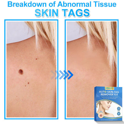 🔥Final 3 Hours: 80% OFF - ODALIT™ Auto Skin Tag Remover Kit 🇺🇸 Made in the USA👨‍⚕️