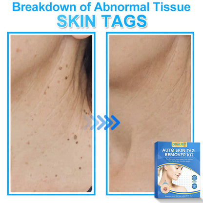🔥Final 3 Hours: 80% OFF - ODALIT™ Auto Skin Tag Remover Kit 🇺🇸 Made in the USA👨‍⚕️