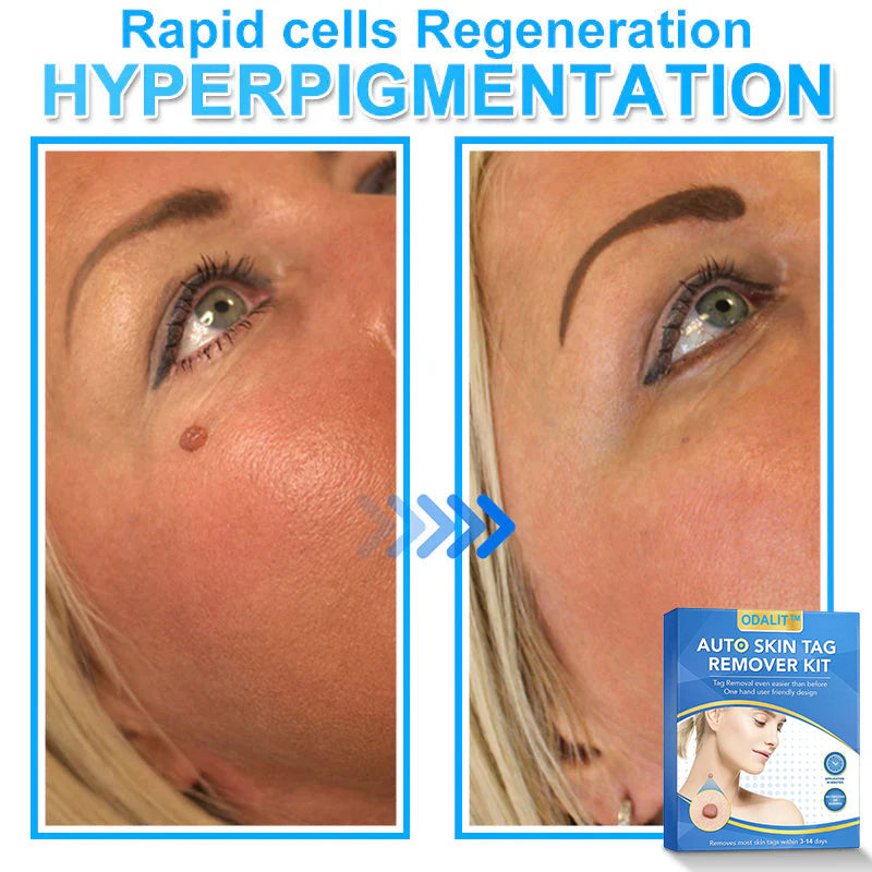 🔥Final 3 Hours: 80% OFF - ODALIT™ Auto Skin Tag Remover Kit 🇺🇸 Made in the USA👨‍⚕️