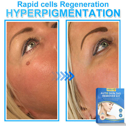 🔥Final 3 Hours: 80% OFF - ODALIT™ Auto Skin Tag Remover Kit 🇺🇸 Made in the USA👨‍⚕️