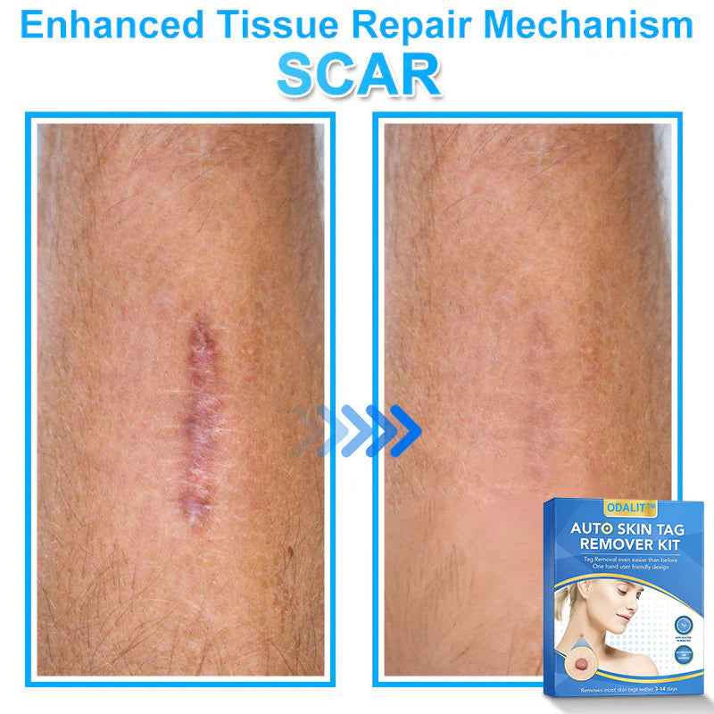 🔥Final 3 Hours: 80% OFF - ODALIT™ Auto Skin Tag Remover Kit 🇺🇸 Made in the USA👨‍⚕️