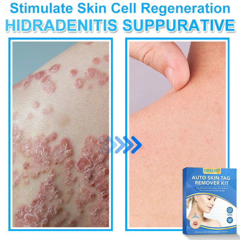 🔥Final 3 Hours: 80% OFF - ODALIT™ Auto Skin Tag Remover Kit 🇺🇸 Made in the USA👨‍⚕️