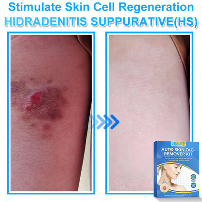 🔥Final 3 Hours: 80% OFF - ODALIT™ Auto Skin Tag Remover Kit 🇺🇸 Made in the USA👨‍⚕️