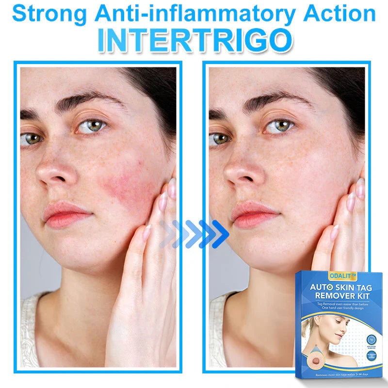 🔥Final 3 Hours: 80% OFF - ODALIT™ Auto Skin Tag Remover Kit 🇺🇸 Made in the USA👨‍⚕️