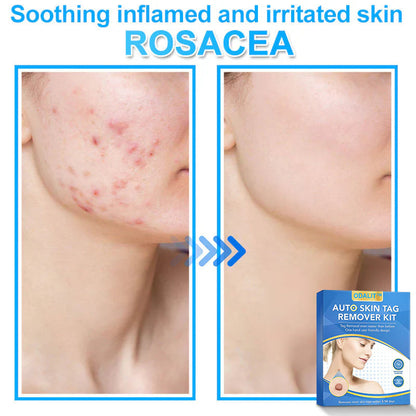 🔥Final 3 Hours: 80% OFF - ODALIT™ Auto Skin Tag Remover Kit 🇺🇸 Made in the USA👨‍⚕️