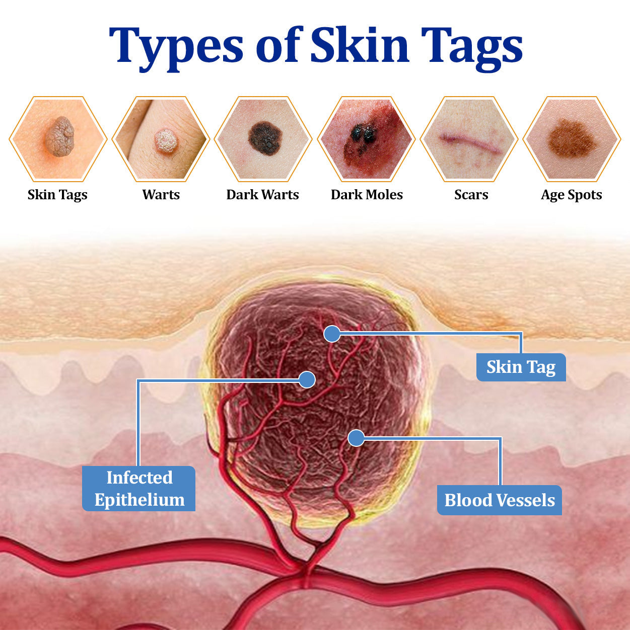 🔥Final 3 Hours: 80% OFF - ODEIUN® BeeDerm RX Cream, Painless, Targeted Treatment for Warts, Skin Tags, Skin Lesions, Infections, Cysts, and Scars💛