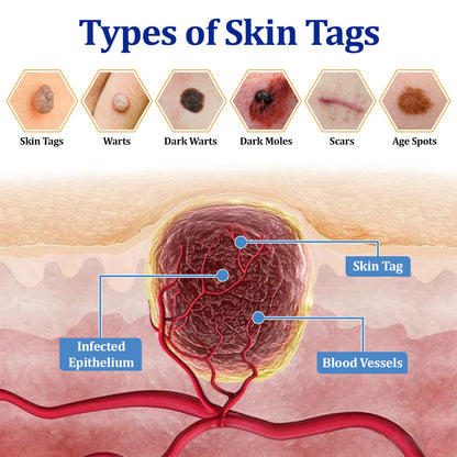 🔥Final 3 Hours: 80% OFF - ODEIUN® BeeDerm RX Cream, Painless, Targeted Treatment for Warts, Skin Tags, Skin Lesions, Infections, Cysts, and Scars💛