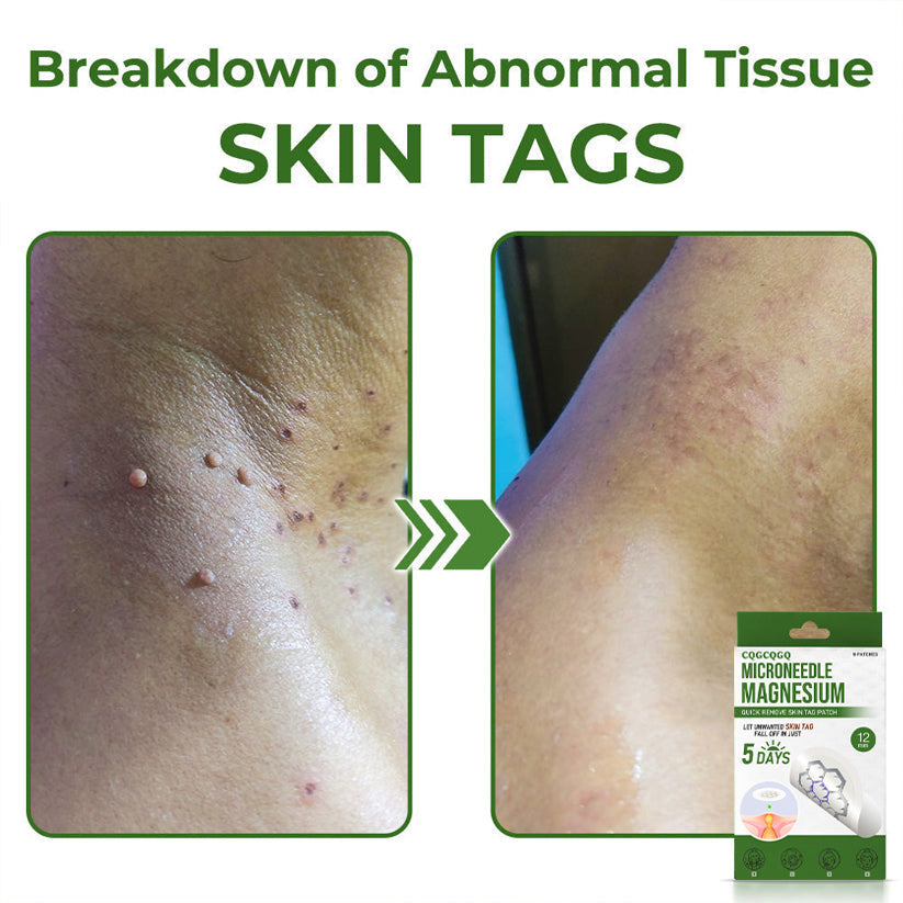 🔥Final 3 Hours: 80% OFF - CQGCQGQ® Magnesium MicroNeedle Quick Remove Skin Tag Patches