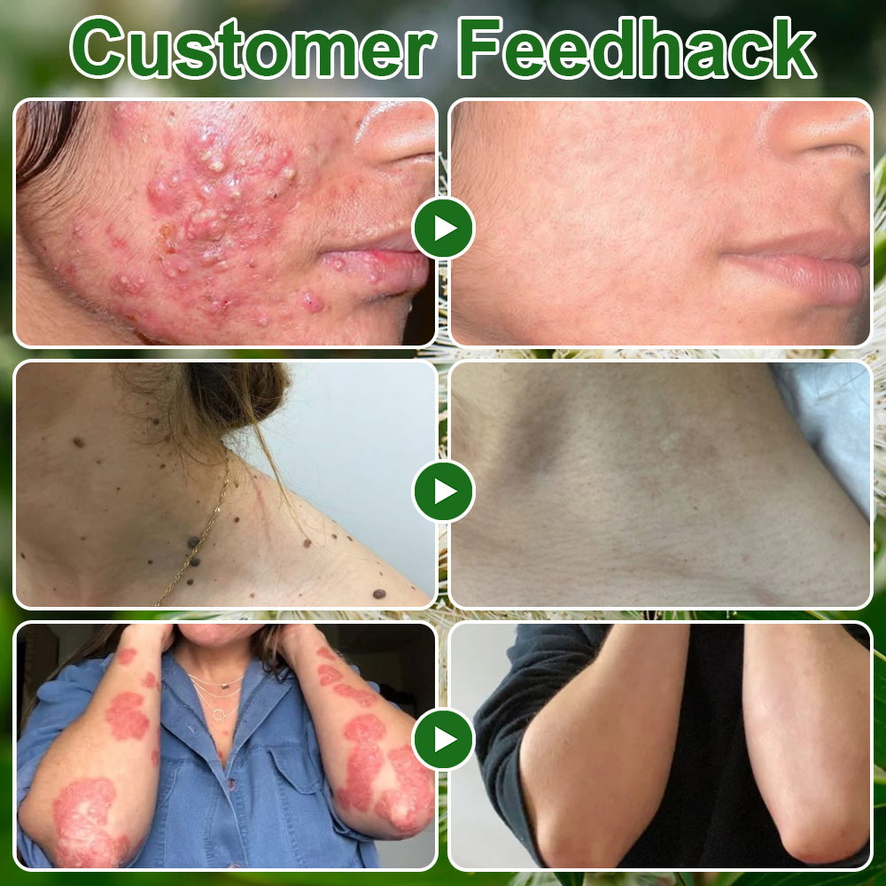 🌿ODALIT® Tea Tree Oil Skin Treatment Cream