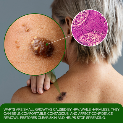 SEURICO® ClinixClear Wart Remover Patch