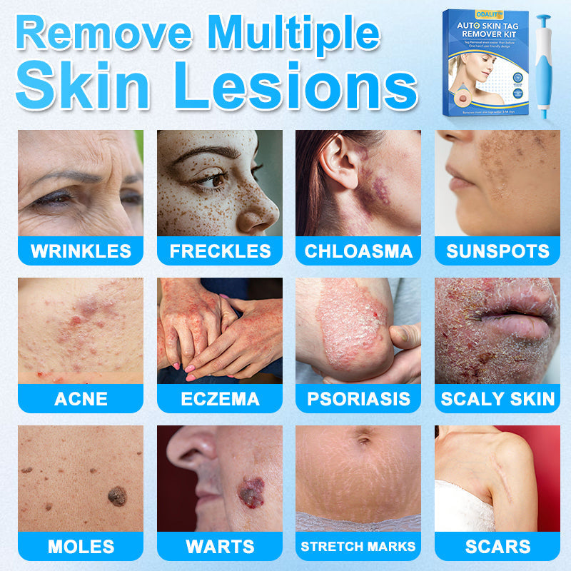 🔥Final 3 Hours: 80% OFF - ODALIT™ Auto Skin Tag Remover Kit 🇺🇸 Made in the USA👨‍⚕️