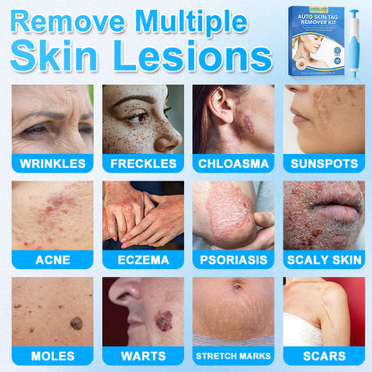 🔥Final 3 Hours: 80% OFF - ODALIT™ Auto Skin Tag Remover Kit 🇺🇸 Made in the USA👨‍⚕️