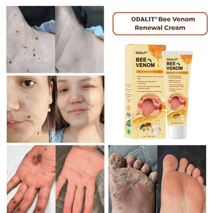 ODALIT® Bee Venom Wart & Mole Eliminate Cream