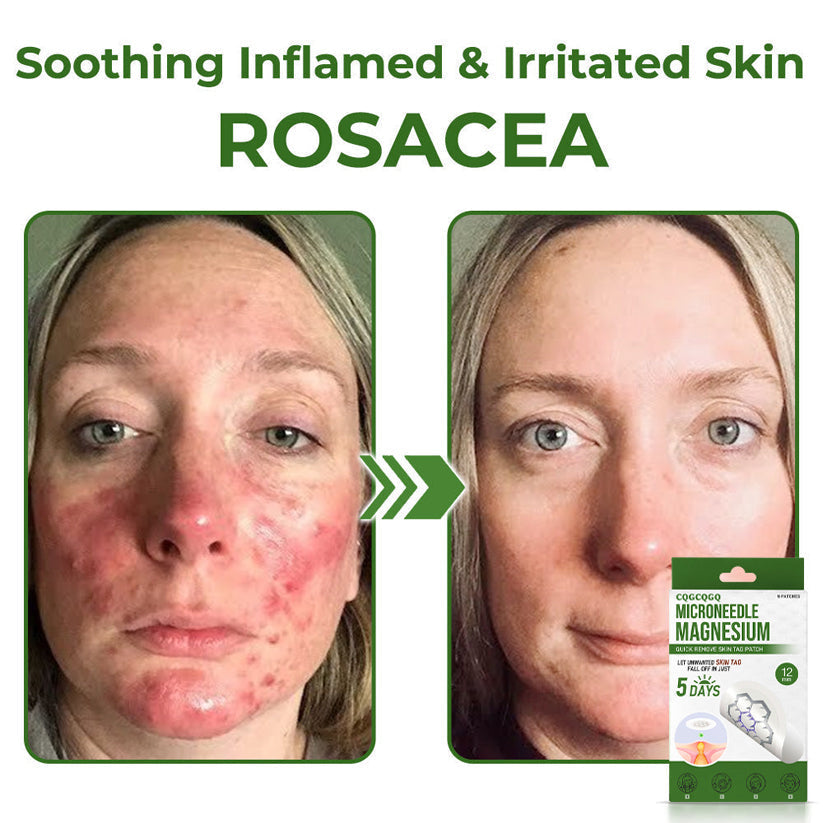 🔥Final 3 Hours: 80% OFF - CQGCQGQ® Magnesium MicroNeedle Quick Remove Skin Tag Patches