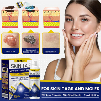 🔥Final 3 Hours: 80% OFF - ODALIT® Skin Tag Cryo Treatment Spray