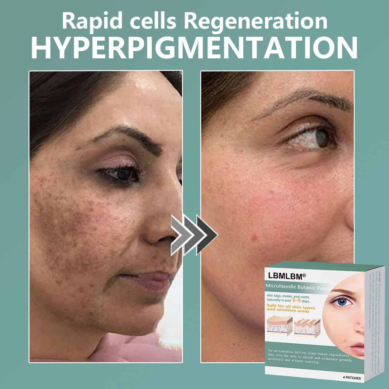 🔥Final 3 Hours: 80% OFF - LBMLBM® MicroNeedle Botanic Skin Tag Removal Patch 🇺🇸 Made in the USA