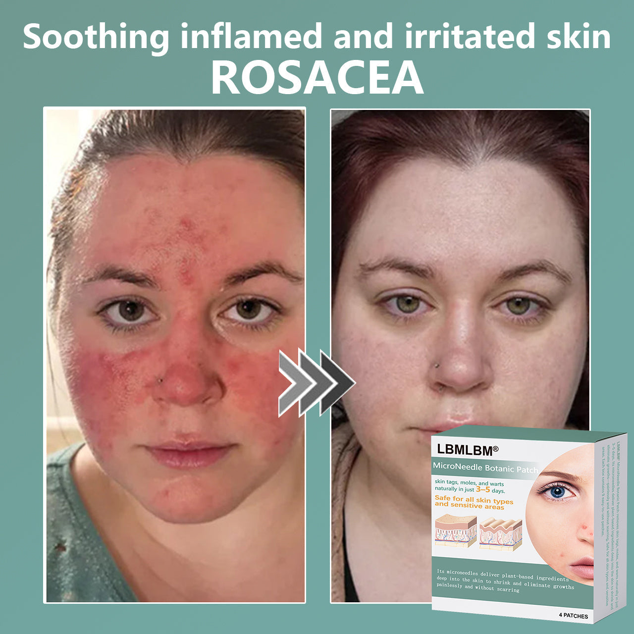 🔥Final 3 Hours: 80% OFF - LBMLBM® MicroNeedle Botanic Skin Tag Removal Patch 🇺🇸 Made in the USA