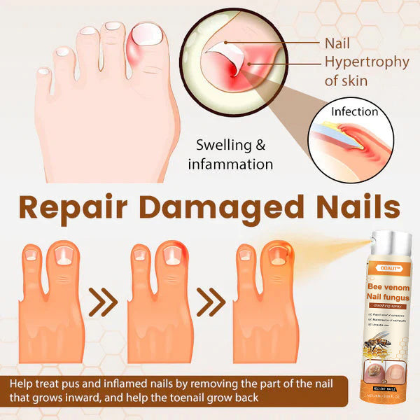 🔥Final 3 Hours: 80% OFF - ODALIT™ Bee Venom Nail Fungus Soothing Spray 🐝