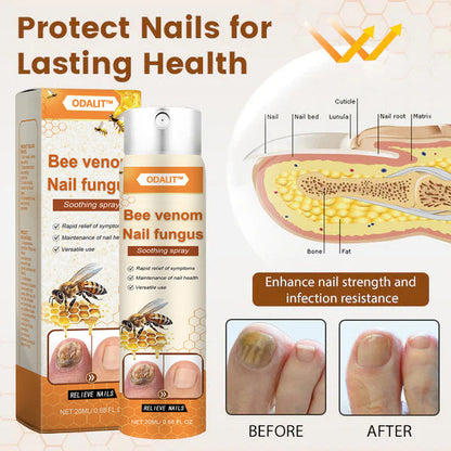 🔥Final 3 Hours: 80% OFF - ODALIT™ Bee Venom Nail Fungus Soothing Spray 🐝