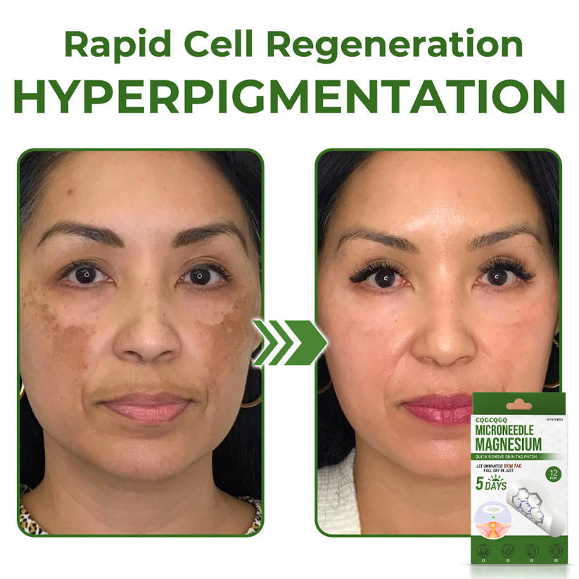 🔥Final 3 Hours: 80% OFF - CQGCQGQ® Magnesium MicroNeedle Quick Remove Skin Tag Patches