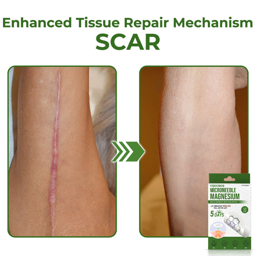 🔥Final 3 Hours: 80% OFF - CQGCQGQ® Magnesium MicroNeedle Quick Remove Skin Tag Patches