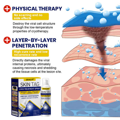 🔥Final 3 Hours: 80% OFF - ODALIT® Skin Tag Cryo Treatment Spray