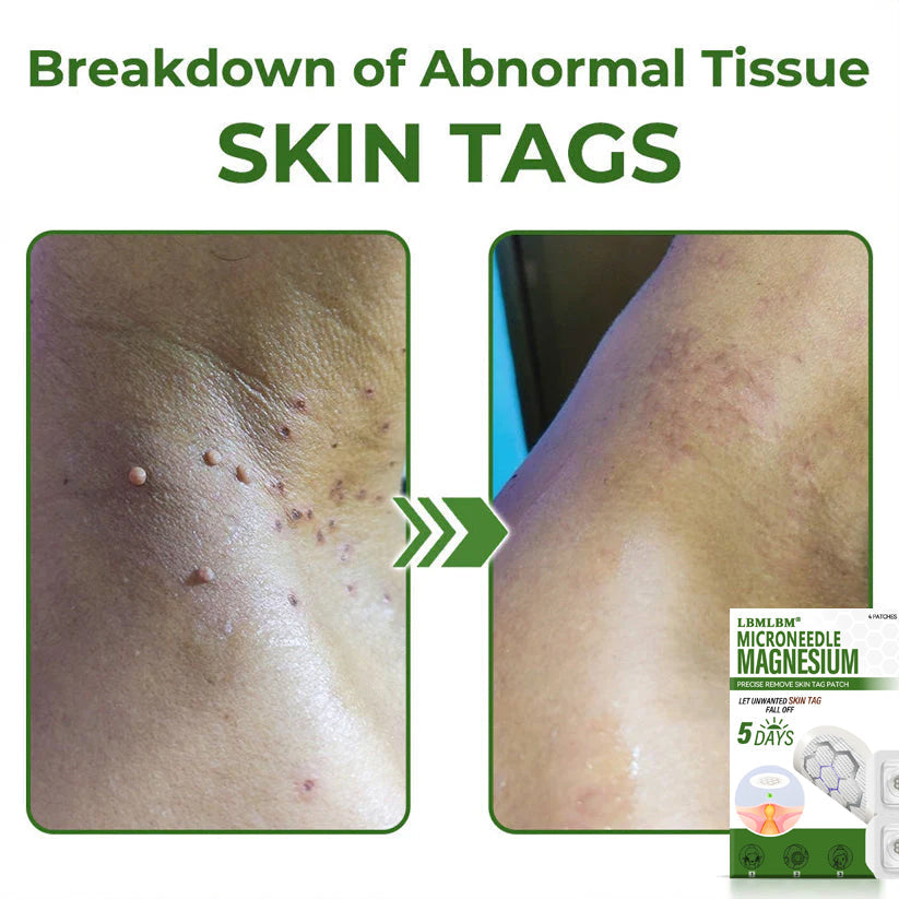 🔥Final 3 Hours: 80% OFF - LBMLBM® Magnesium MicroNeedle Precise Remove Skin Tag Patches