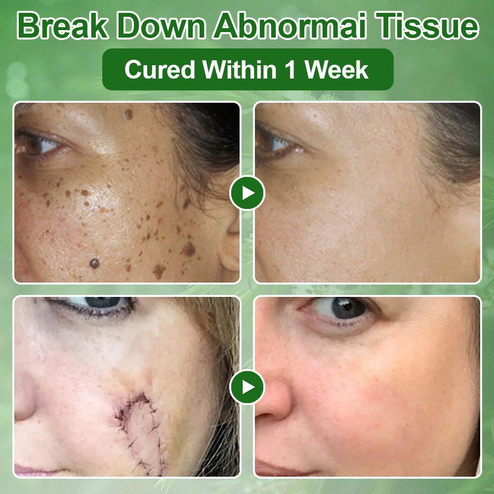 🌿ODALIT® Tea Tree Oil Skin Treatment Cream