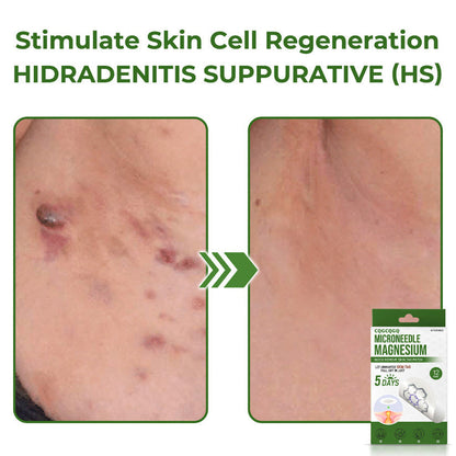 🔥Final 3 Hours: 80% OFF - CQGCQGQ® Magnesium MicroNeedle Quick Remove Skin Tag Patches