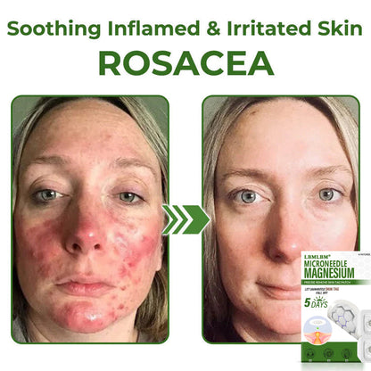 🔥Final 3 Hours: 80% OFF - LBMLBM® Magnesium MicroNeedle Precise Remove Skin Tag Patches