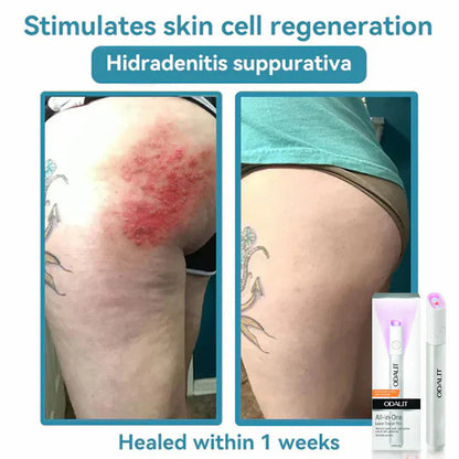 🔥Final 3 Hours: 80% OFF - ODALIT® All-in-One CO₂ Laser Eraser Pen | Removes Moles, Warts, Skin Flaws & Pigmentation