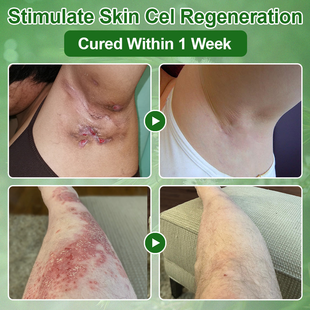 🌿ODALIT® Tea Tree Oil Skin Treatment Cream