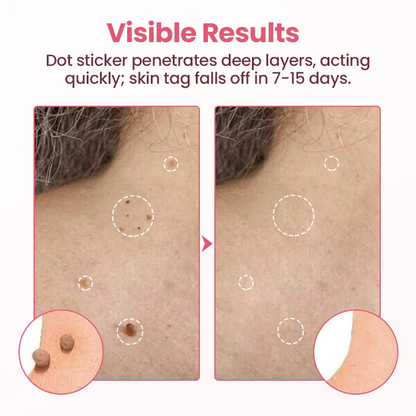 ODEIUN® Painless Micro Wart Removal Patch