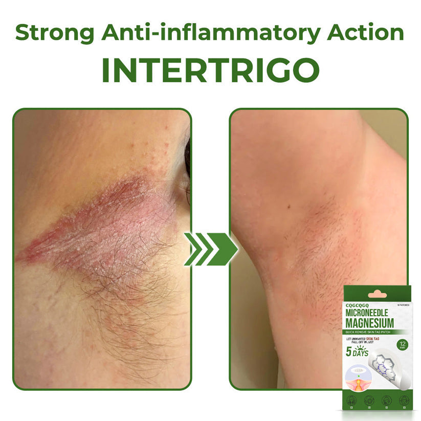 🔥Final 3 Hours: 80% OFF - CQGCQGQ® Magnesium MicroNeedle Quick Remove Skin Tag Patches