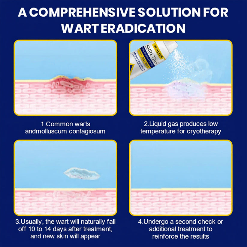 🔥Final 3 Hours: 80% OFF - ODALIT® Skin Tag Cryo Treatment Spray