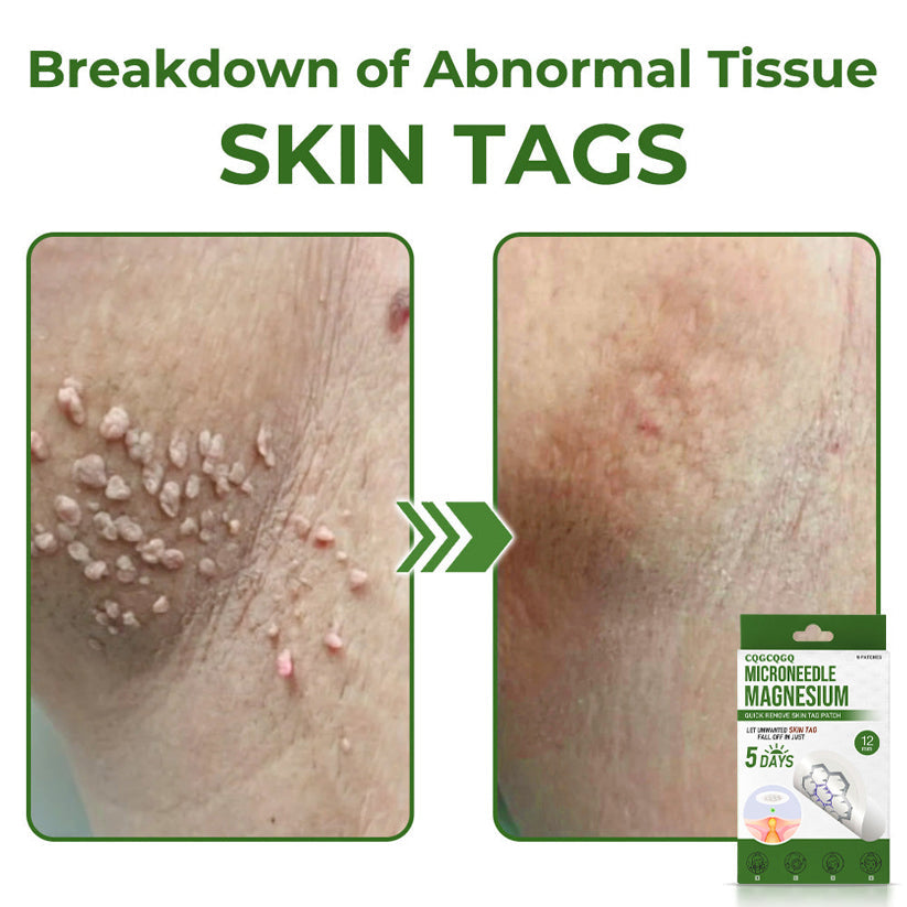 🔥Final 3 Hours: 80% OFF - CQGCQGQ® Magnesium MicroNeedle Quick Remove Skin Tag Patches