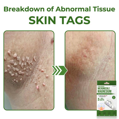 🔥Final 3 Hours: 80% OFF - CQGCQGQ® Magnesium MicroNeedle Quick Remove Skin Tag Patches