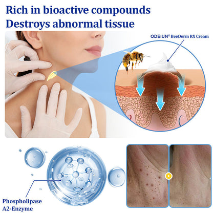 🔥Final 3 Hours: 80% OFF - ODEIUN® BeeDerm RX Cream, Painless, Targeted Treatment for Warts, Skin Tags, Skin Lesions, Infections, Cysts, and Scars💛