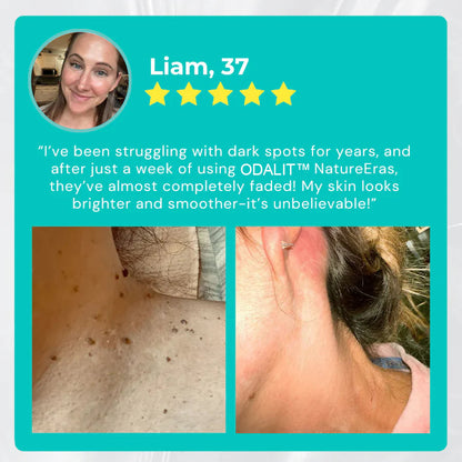 🔥Final 3 Hours: 80% OFF - ODALIT™ NatureErase Instant Mole & Spot Cream