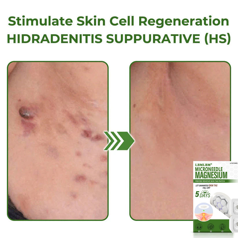 🔥Final 3 Hours: 80% OFF - LBMLBM® Magnesium MicroNeedle Precise Remove Skin Tag Patches